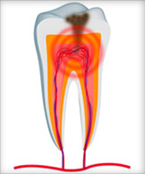 Root canal therapy with Dr. Jenson of Cascade Endodontics