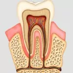 Endodontics tooth example in Utah County