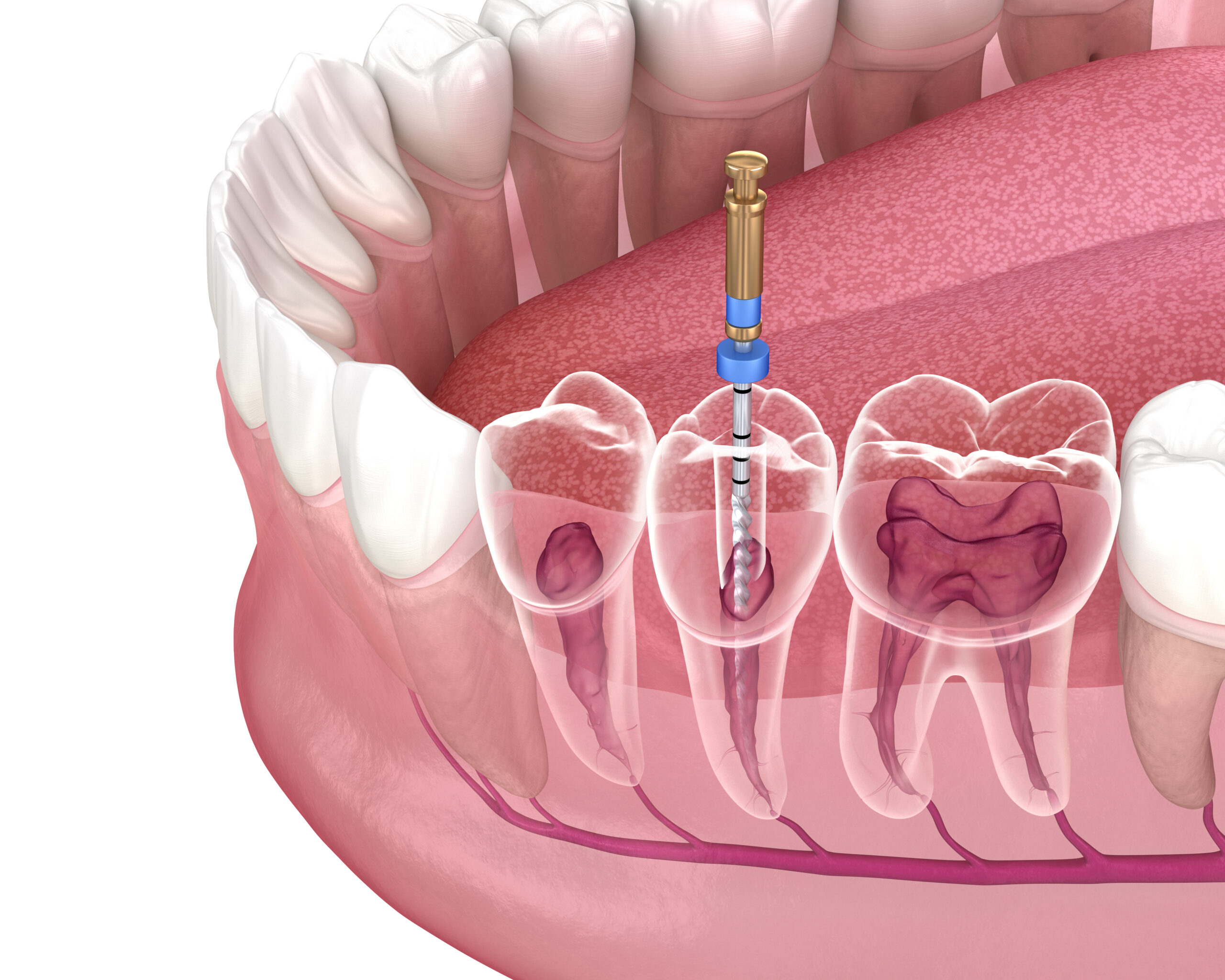 Root Canal Facts and Statistics Endodontics Cascade Endodontics