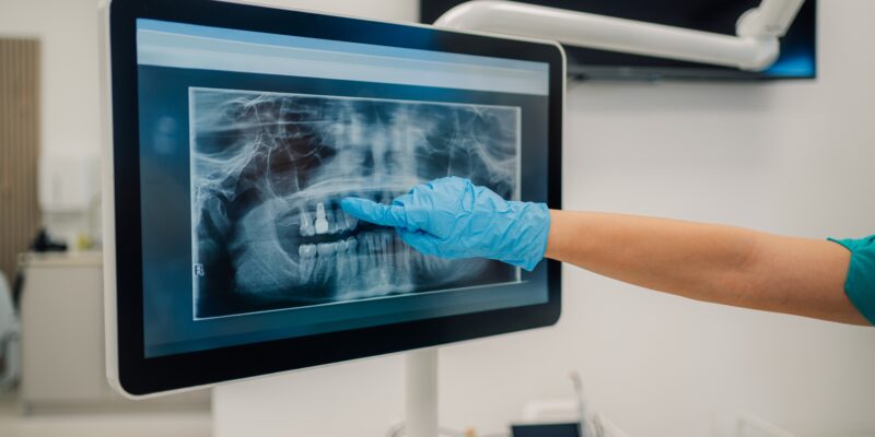Dentist wearing blue medical gloves is pointing at teeth x ray displayed on a digital monitor in a modern dental office