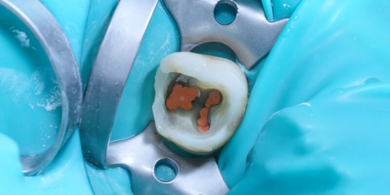 closeup of a tooth injury, root canal therapy